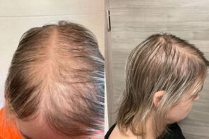 Diffuser Haarverlust vor einer Haarersatzversorgung
